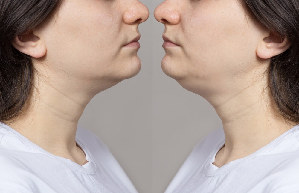 woman-with-double-chin-before-after-treatment_528985-300.jpg